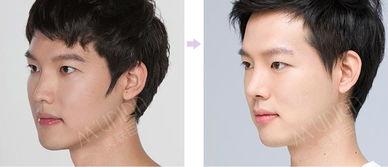 爆料整形鼻子视频大全,鼻子整形视频大全大曝光  第3张